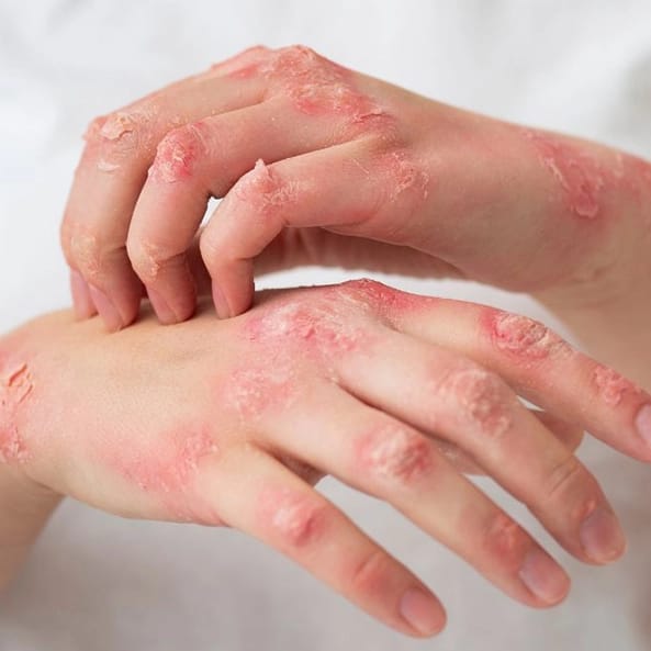 manos con signos claros de estar enfermas por no tener buenos hábitos en la higiene de manos